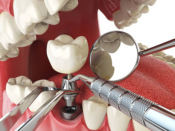 Best Knocked-Out Tooth (Avulsed Tooth) Treatment in Hodgkins, IL